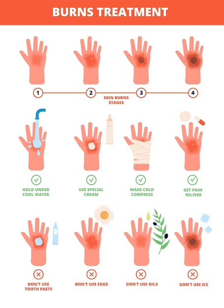 皮膚のやけど 火傷の手治療 保護火傷 応急処置と治療 火傷の段階 フラットな医療のイラスト 燃え尽き症候群の皮膚の手 損傷および医療の程度 プレミアムベクター
