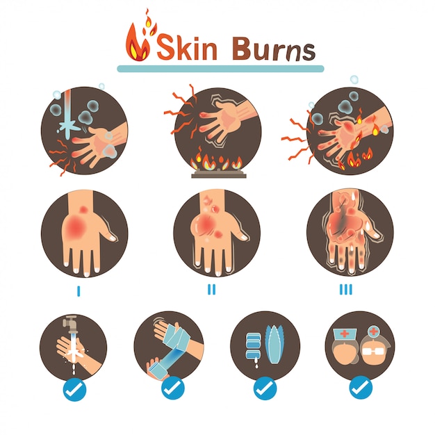 Premium Vector | Skin Burns Infographics