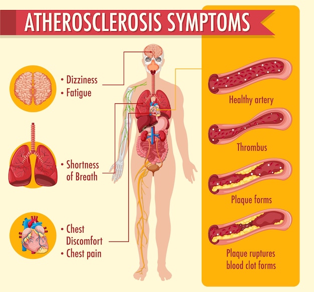 Free Vector Stages of atherosclerosis information infographic