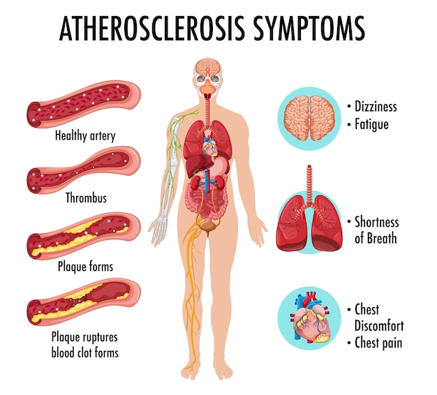 free-vector-stages-of-atherosclerosis-information-infographic