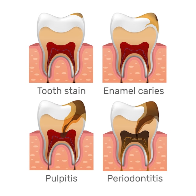 Premium Vector | Stages of caries tooth decay