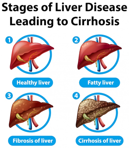 Stages of liver disease leading to cirrhosis | Free Vector