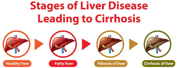 Free Vector | Stages of liver disease leading to cirrhosis