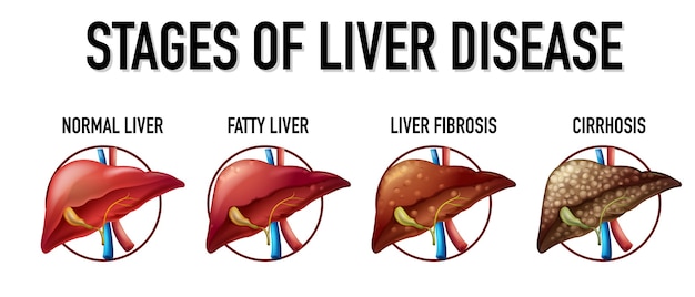 Free Vector | Stages of liver disease