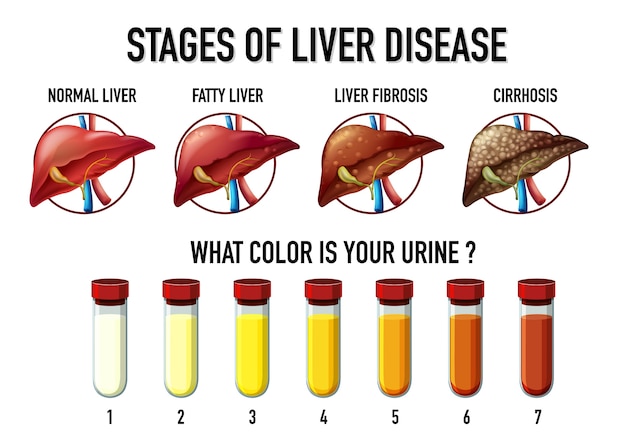 free-vector-stages-of-liver-disease