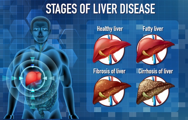 Free Vector | Stages of liver disease