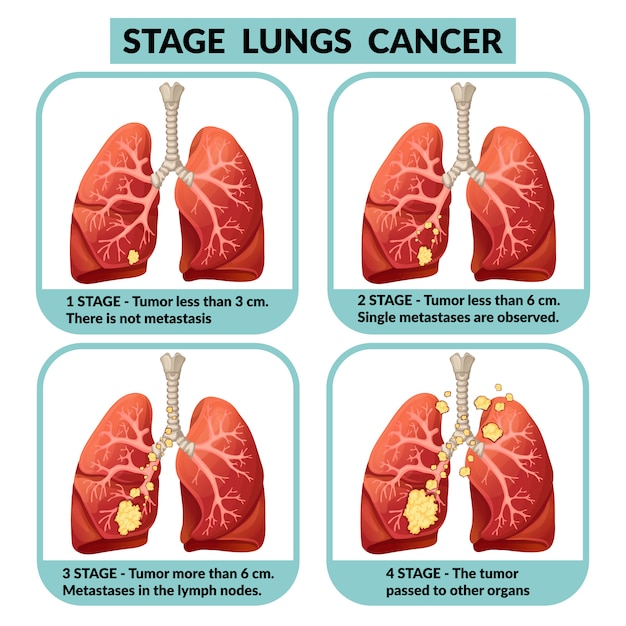 what is the presentation of lung cancer