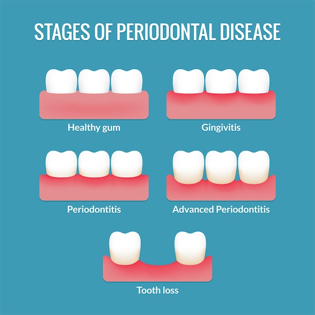 Premium Vector | Stages Of Periodontal Disease From Healthy Gums To ...