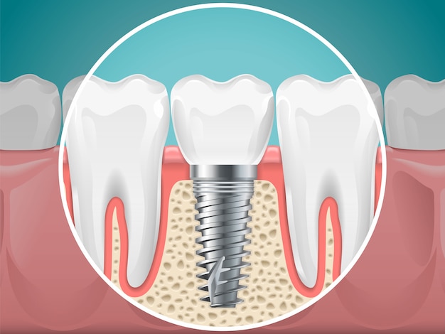 口腔病学のイラスト 歯科インプラントと健康な歯ベクトル健康歯とインプラント口腔病学 歯科のインストールとフィクスチャ プレミアムベクター
