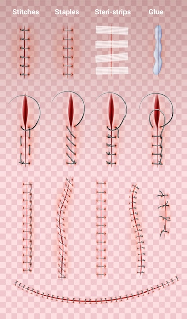 Suture Stitch Types