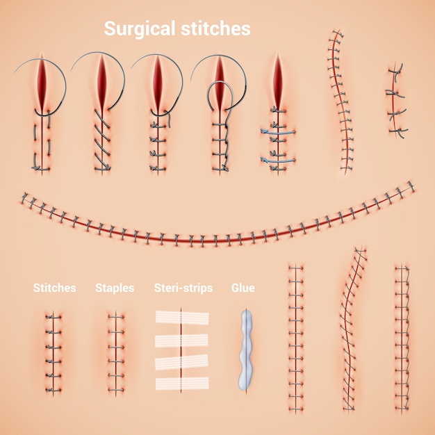 Free Vector | Surgical suture stitches realistic set of stitching ...