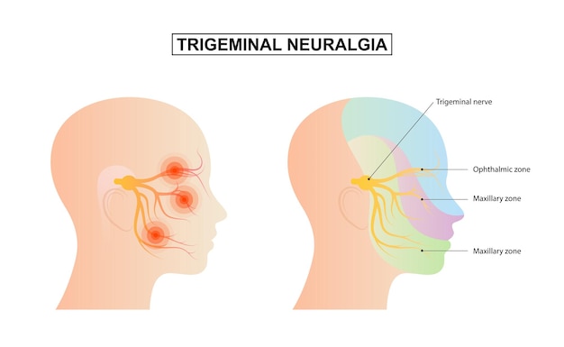 Trigeminal Neuralgia Images Free Vectors Stock Photos Psd