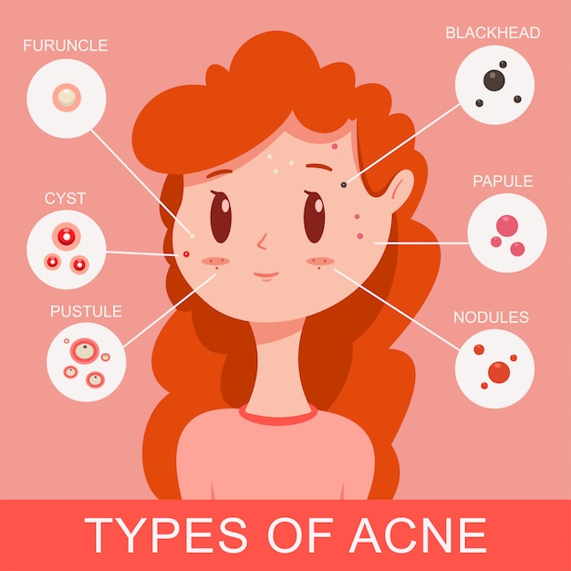 Premium Vector | Types of acne infographics. cute young girl with