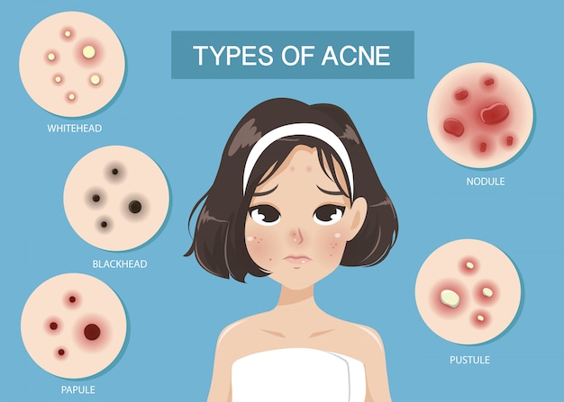 Types of acne Premium Vector
