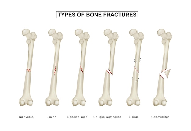 Premium Vector Types Of Bone Fractures Femoral Shaft Fracture The Best Porn Website