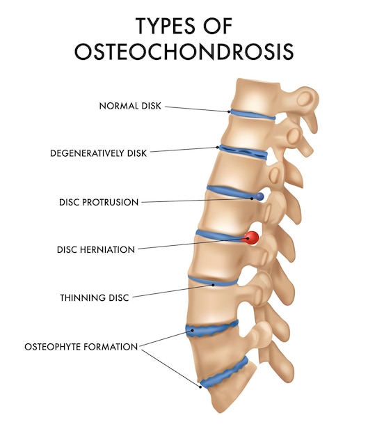 spinal osteochondrosis