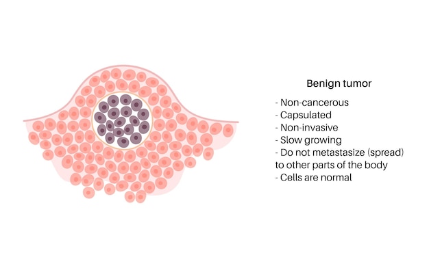 Premium Vector | Vector isolated illustration of benign tumor in tissue ...