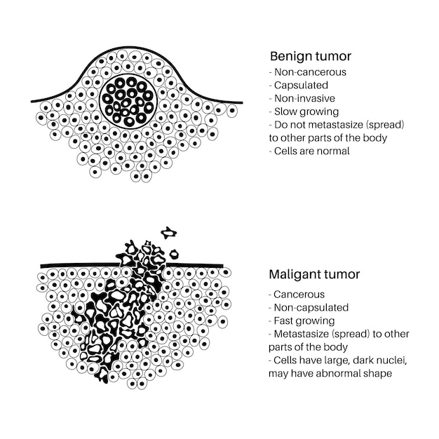 Premium Vector | Vector isolated illustration of malignant and benign ...