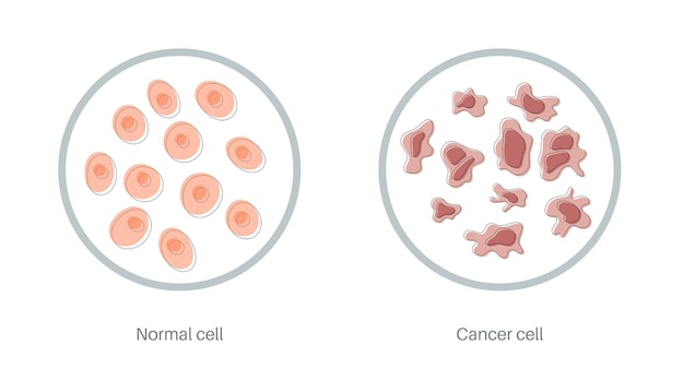 細胞構造のベクトル分離イラスト 正常と癌 ポスター 教育 科学 医療用の医療図 がんのアイコンまたはロゴ プレミアムベクター