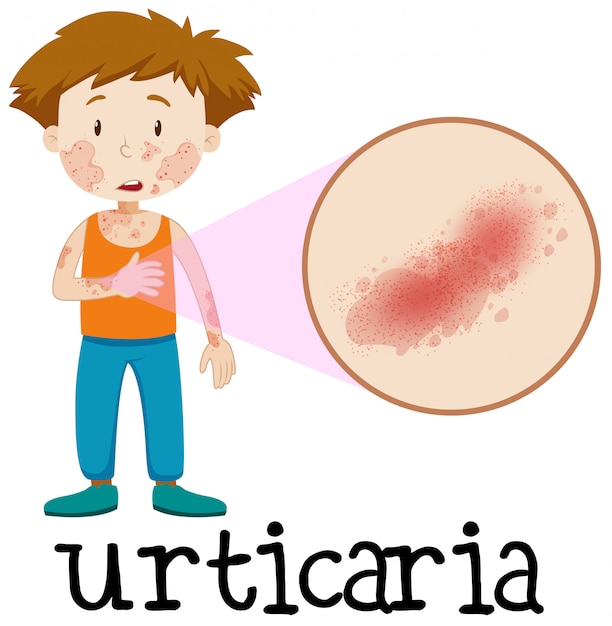 A Vector Of Skin Urticaria Premium Vector 3119