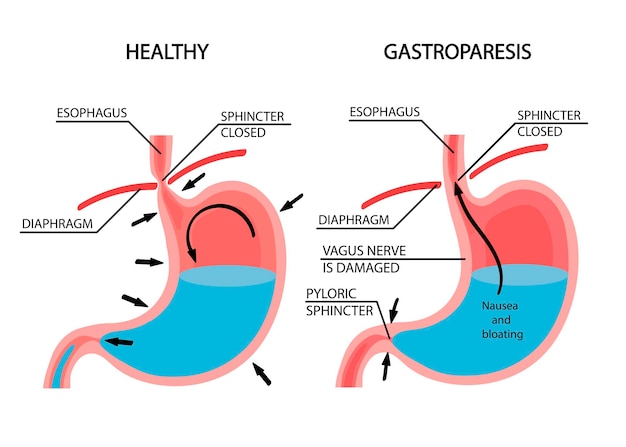 premium-vector-visual-comparison-of-healthy-gastric-and-stomach-with