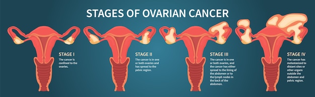 Premium Vector | Woman reproductive system with ovarian cancer stages