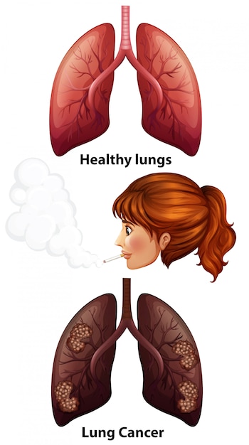 Download Women smoking with healthy and cancer lungs Vector | Free Download