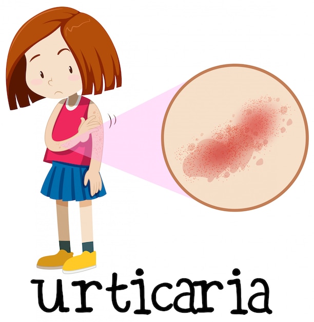 A young girl having urticaria | Premium Vector