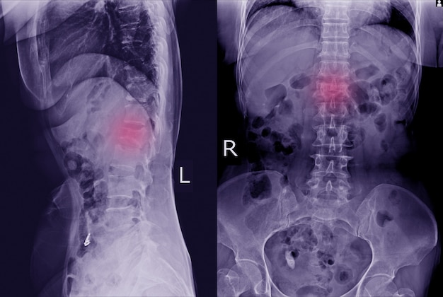 Colonne vertébrale ls à rayons x: trouver une fracture de compression modérée de la vertèbre l1. Photo Premium