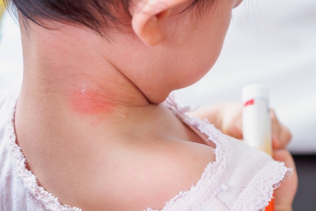 Eruption Cutanee Et Allergie Chez Le Bebe Avec Tache Rouge Causee Par Une Piqure De Moustique Au Cou Photo Premium