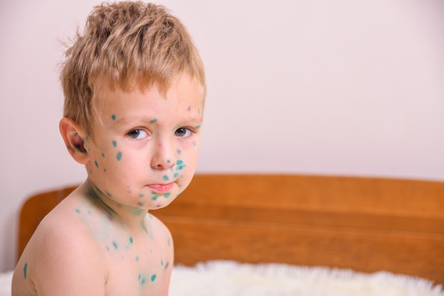 Jeune Enfant En Bas Age Garcon Avec La Varicelle Enfant Malade Avec Varicelle Virus De La Varicelle Ou Eruption Cutanee A La Varicelle Sur Le Corps Et Le Visage De L Enfant