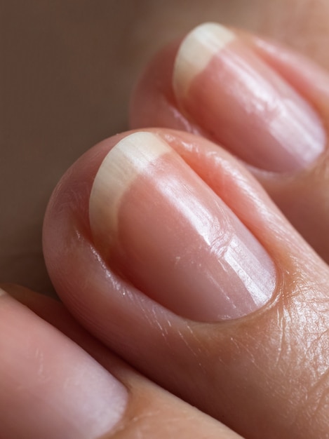 Ongles Abîmés Après Le Vernis Gel. | Photo Premium