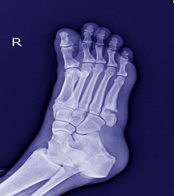 Pied x-ray: 5ème fracture de la base métatarsienne petit os.fracture pied. Photo Premium