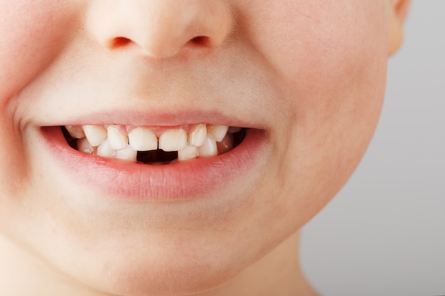 Un Sourire D Enfant Sans Dents De Bebe Inferieures Un Trou Dans Le Sourire D Un Enfant Concept Amusant Photo Premium