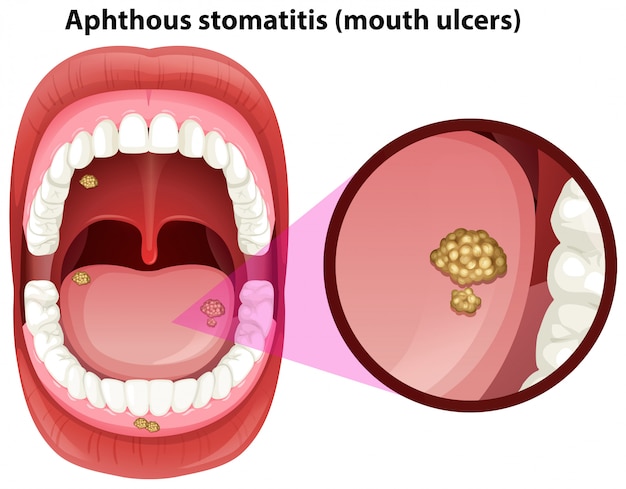 Anatomie De La Bouche Humaine Des Ulcères | Vecteur Premium