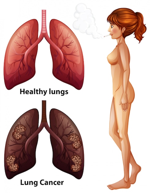 Anatomie Humaine Poumon De Fumeur Vecteur Premium