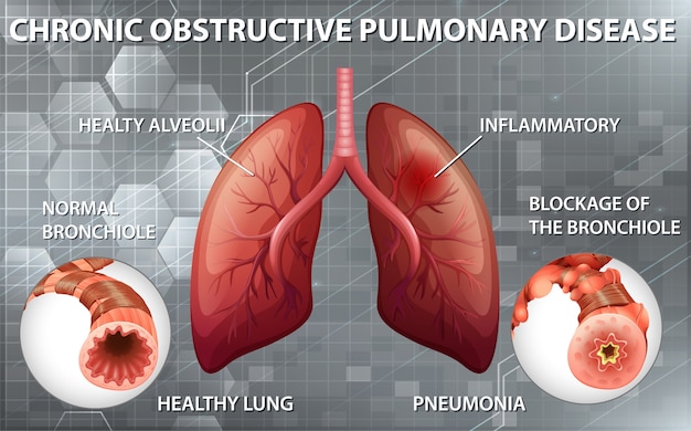 Bronchopneumopathie Chronique Obstructive | Vecteur Gratuite