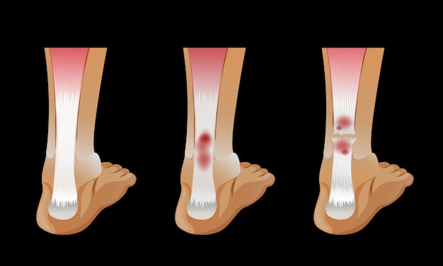 Diagramme Montrant L Os Casse Dans Le Pied Humain Vecteur Gratuite