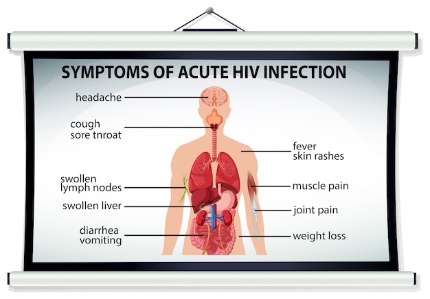 Diagramme Montrant Les Sympt Mes D Une Infection Aigu Par Le Vih