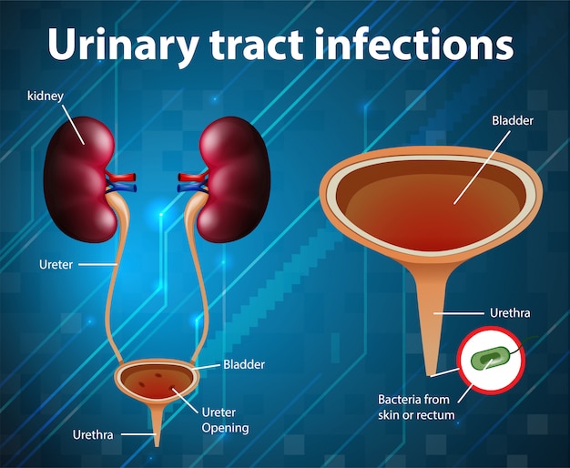 Illustration Informative Des Infections Des Voies Urinaires | Vecteur ...