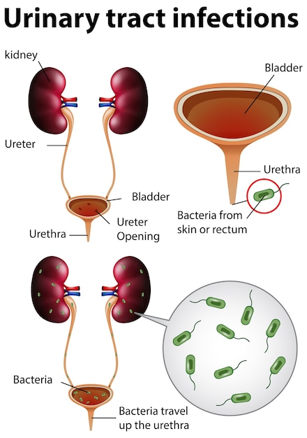 Illustration Informative Des Infections Des Voies Urinaires | Vecteur ...