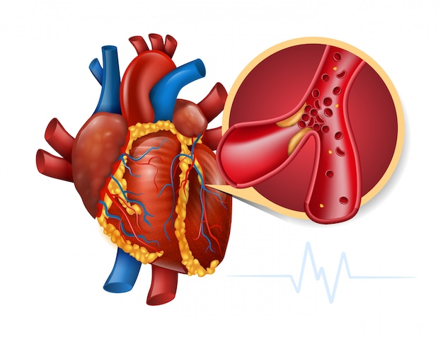 Infarctus Du Myocarde | Vecteur Premium