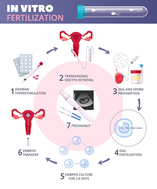 Infographie De Fécondation In Vitro Fertilisation Colorée à Plat Avec