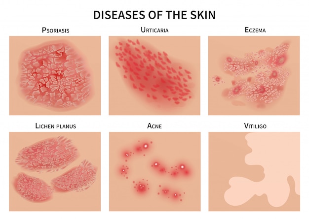 Maladies De La Peau. Infection Dermique, Eczéma Et Psoriasis ...