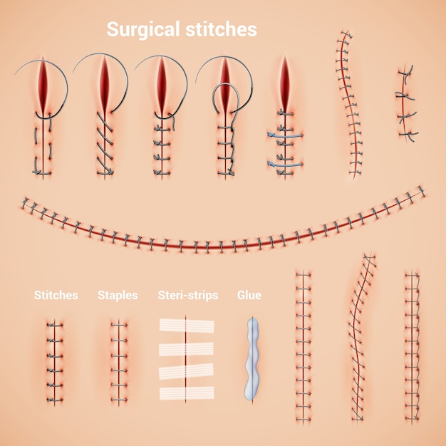 Points De Suture Chirurgicaux Ensemble Réaliste De Méthodes Et De ...