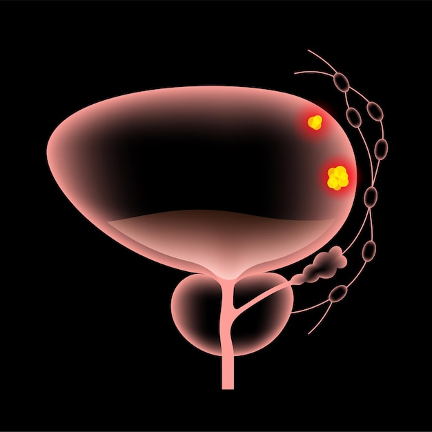 Stades Du Cancer De La Vessie Affiche Anatomique Réaliste 3d