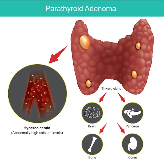 Adenoma De Paratiroides Ilustraci N Para Explicar La Gl Ndula Tiroides