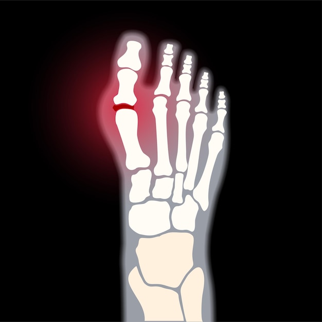 Artritis del pie dolor reumatoide en la ilustración de vector plano de