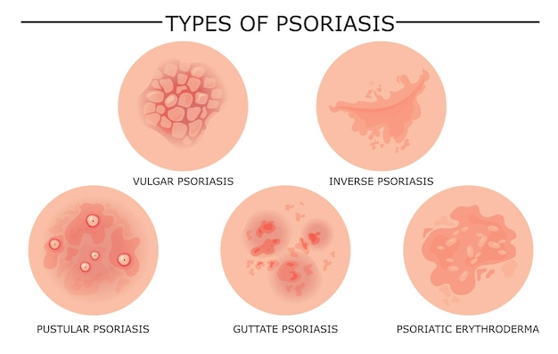 tipos de psoriasis (fotos)