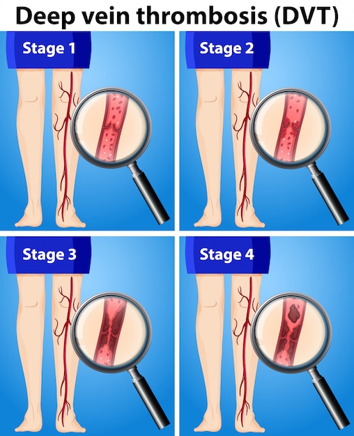 varicoza 3 etapa